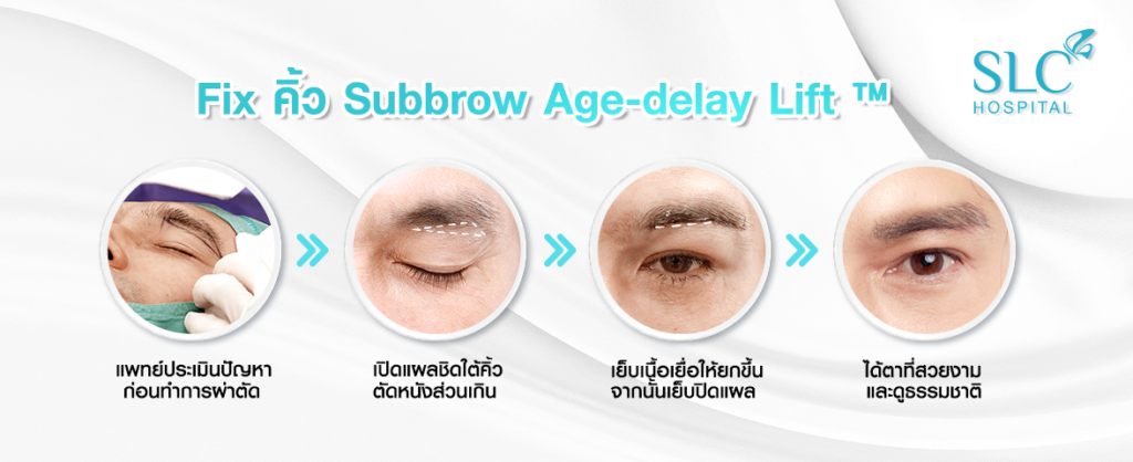 Subbrow-Age-delay-Lift ™