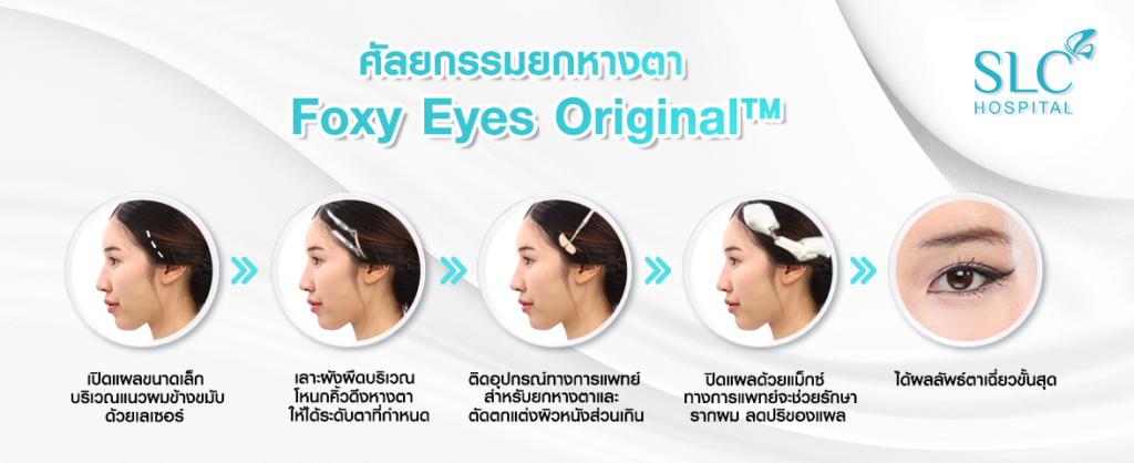 ผ่าตัดศัลยกรรมยกหางตา เทคนิค foxy eyes original™