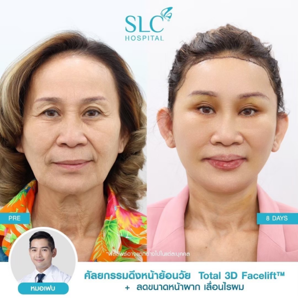 รวมรีวิวดึงหน้า กับ SLC Hospital