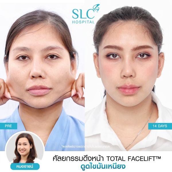 รวมรีวิวดึงหน้า กับ SLC Hospital