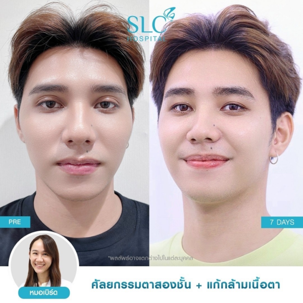 ศัลกรรมตาสองชั้น