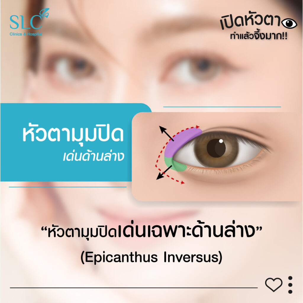 หัวตามุมปิดด้านล่างEpicanthus Inversus