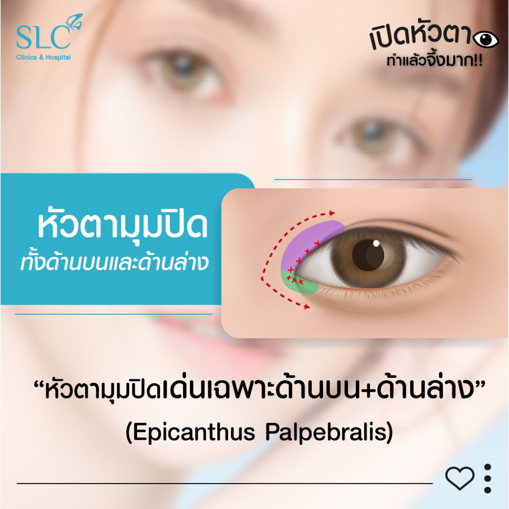 หัวตามุมปิดด้านบนด้านล่างEpicanthus Palpebralis