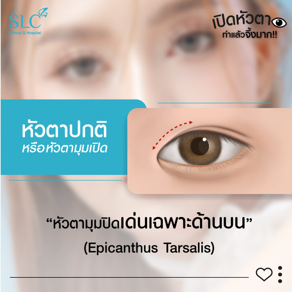 หัวตาปกติEpicanthus Tarsalis