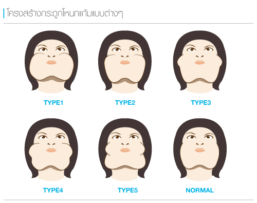 โหนกแก้มสูงลักษณะเป็นอย่างไร