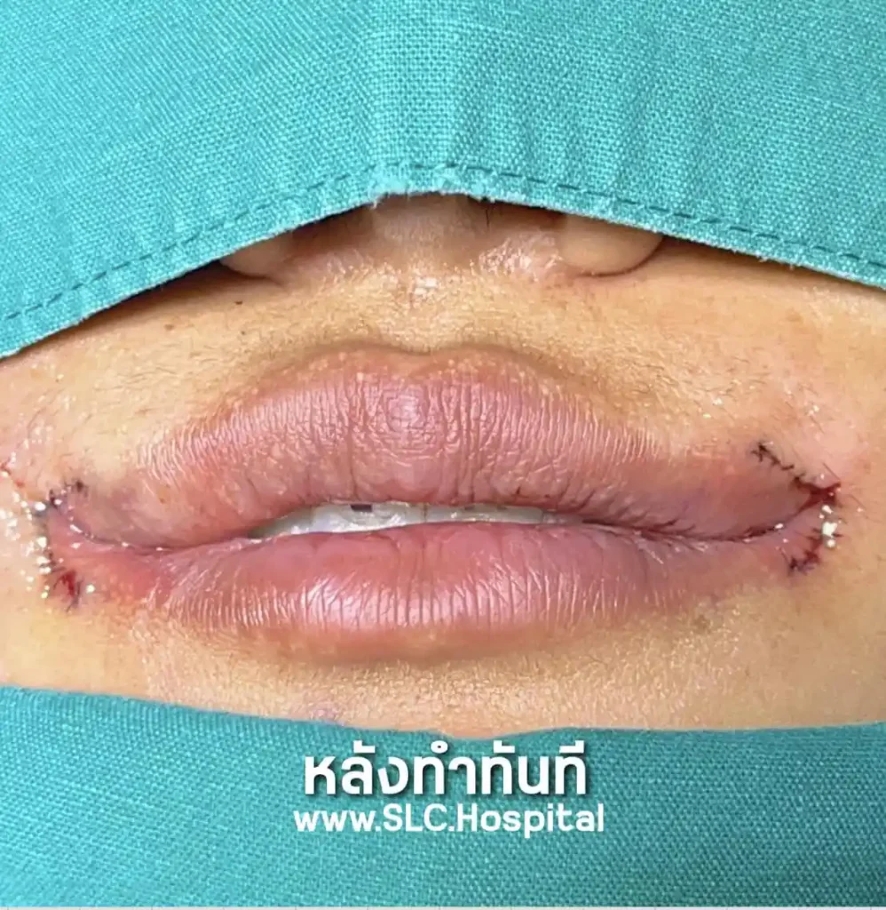 ขั้นตอนศัลยกรรมยกมุมปาก