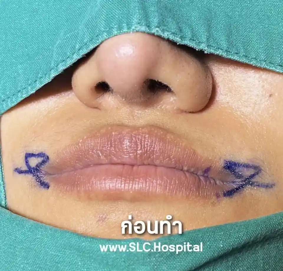 ขั้นตอนศัลยกรรมยกมุมปาก