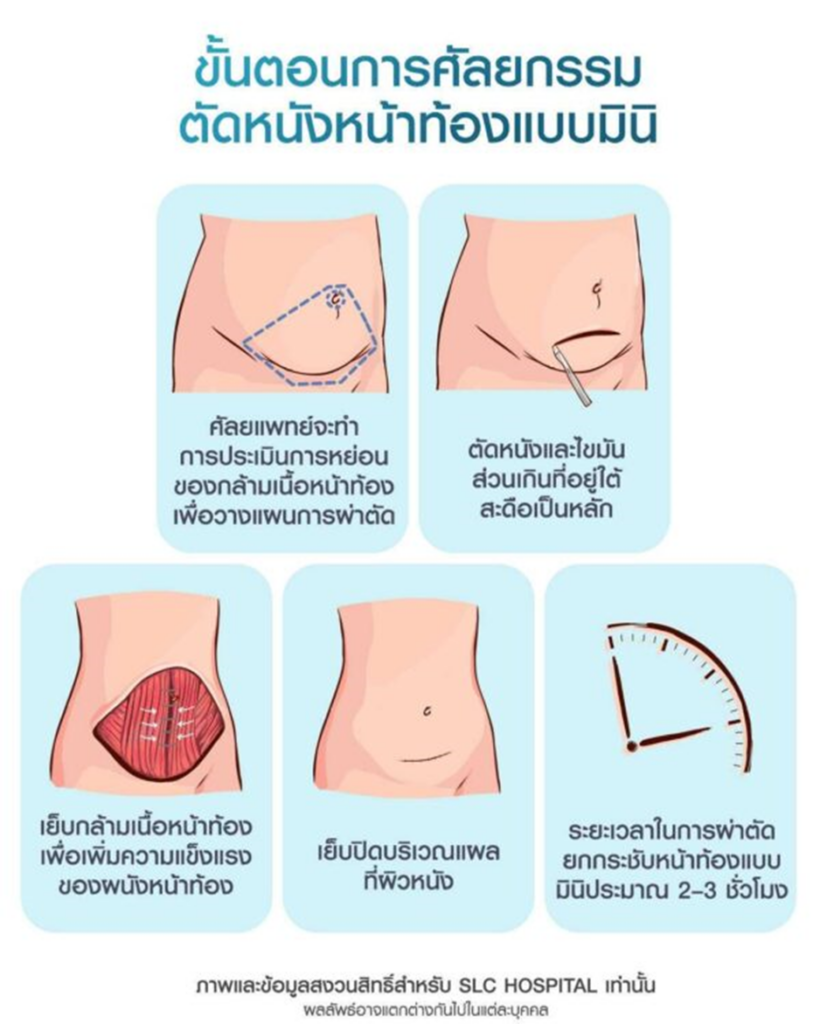 ตัดหนังหน้าท้อง