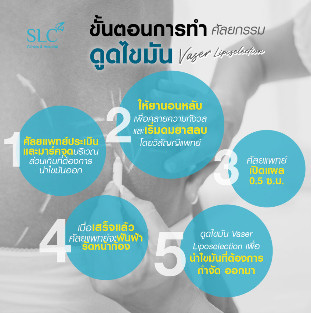 ดูดไขมัน Vaser LipoSelection