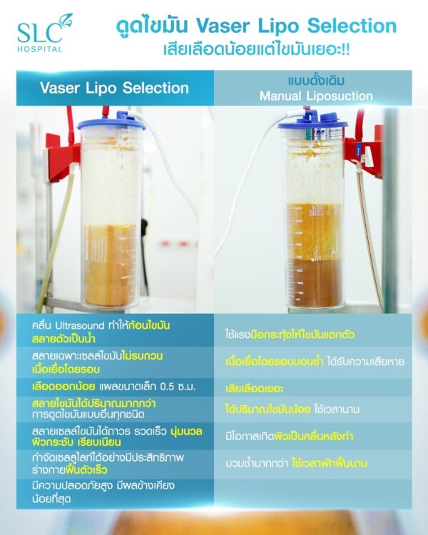 ดูดไขมัน Vaser LipoSelection