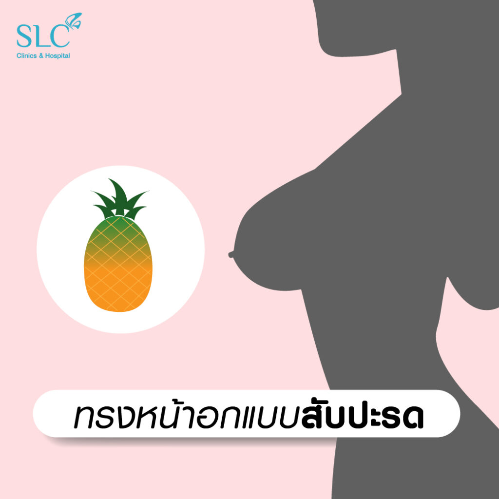 ทรงหน้าอกแบบสับปะรด