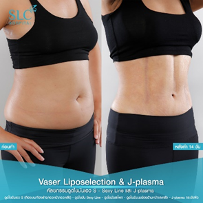 ดูดไขมัน Vaser LipoSelection