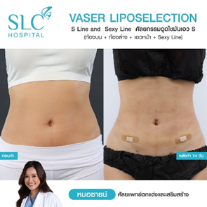 ดูดไขมัน Vaser LipoSelection