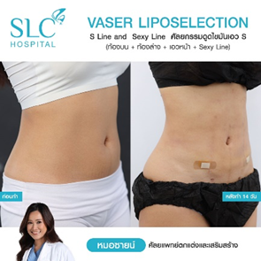 ดูดไขมัน Vaser LipoSelection