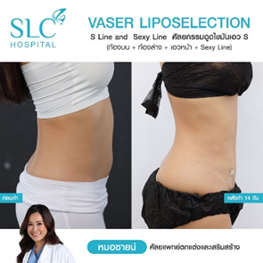 ดูดไขมัน Vaser LipoSelection