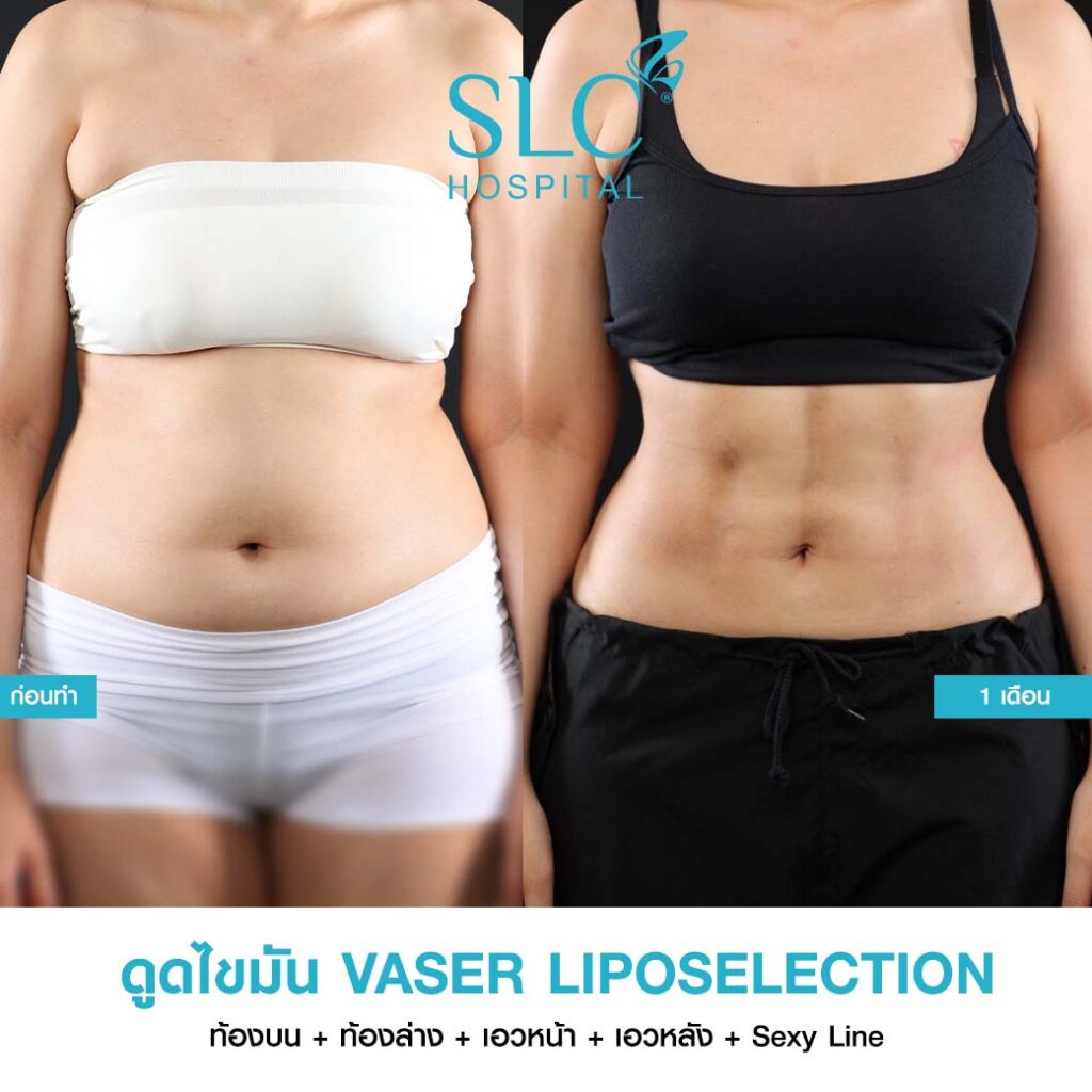 ดูดไขมัน Vaser LipoSelection