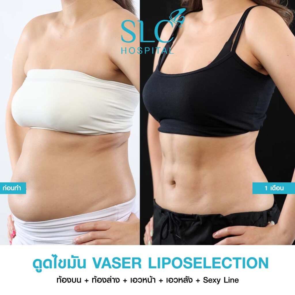 ดูดไขมัน Vaser LipoSelection