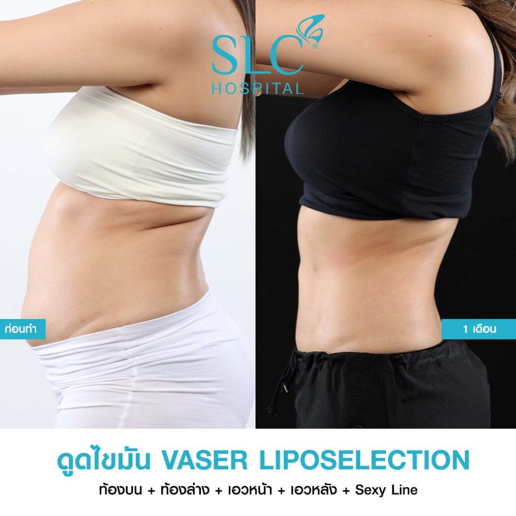 ดูดไขมัน Vaser LipoSelection