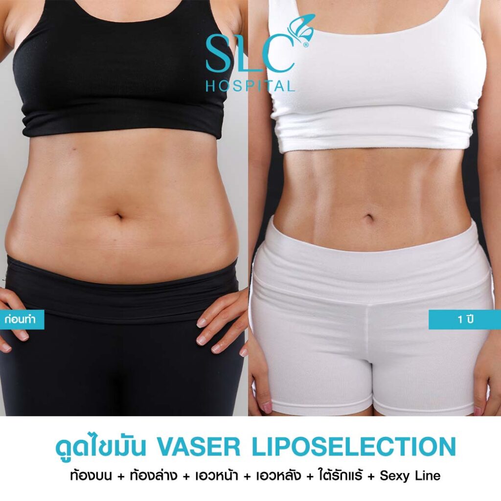 ดูดไขมัน Vaser LipoSelection