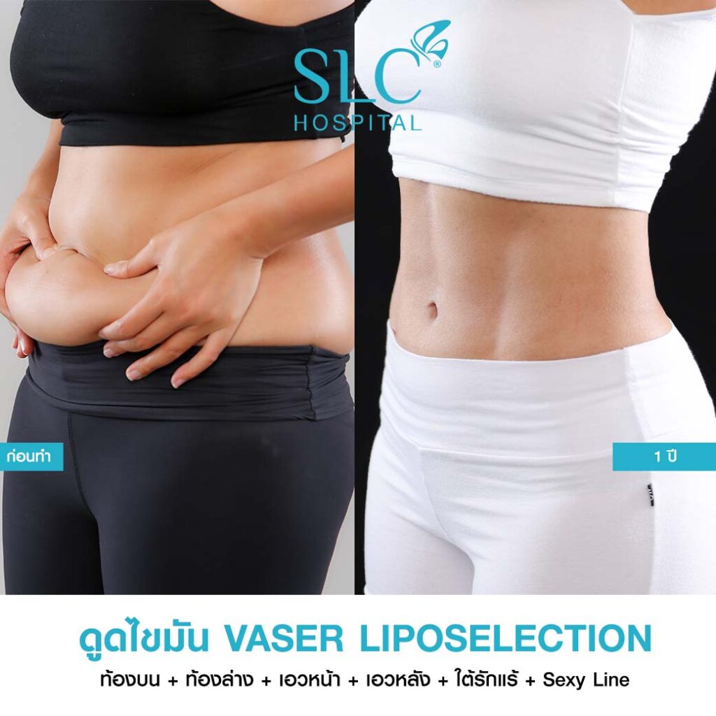 ดูดไขมัน Vaser LipoSelection