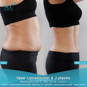 ดูดไขมัน Vaser LipoSelection