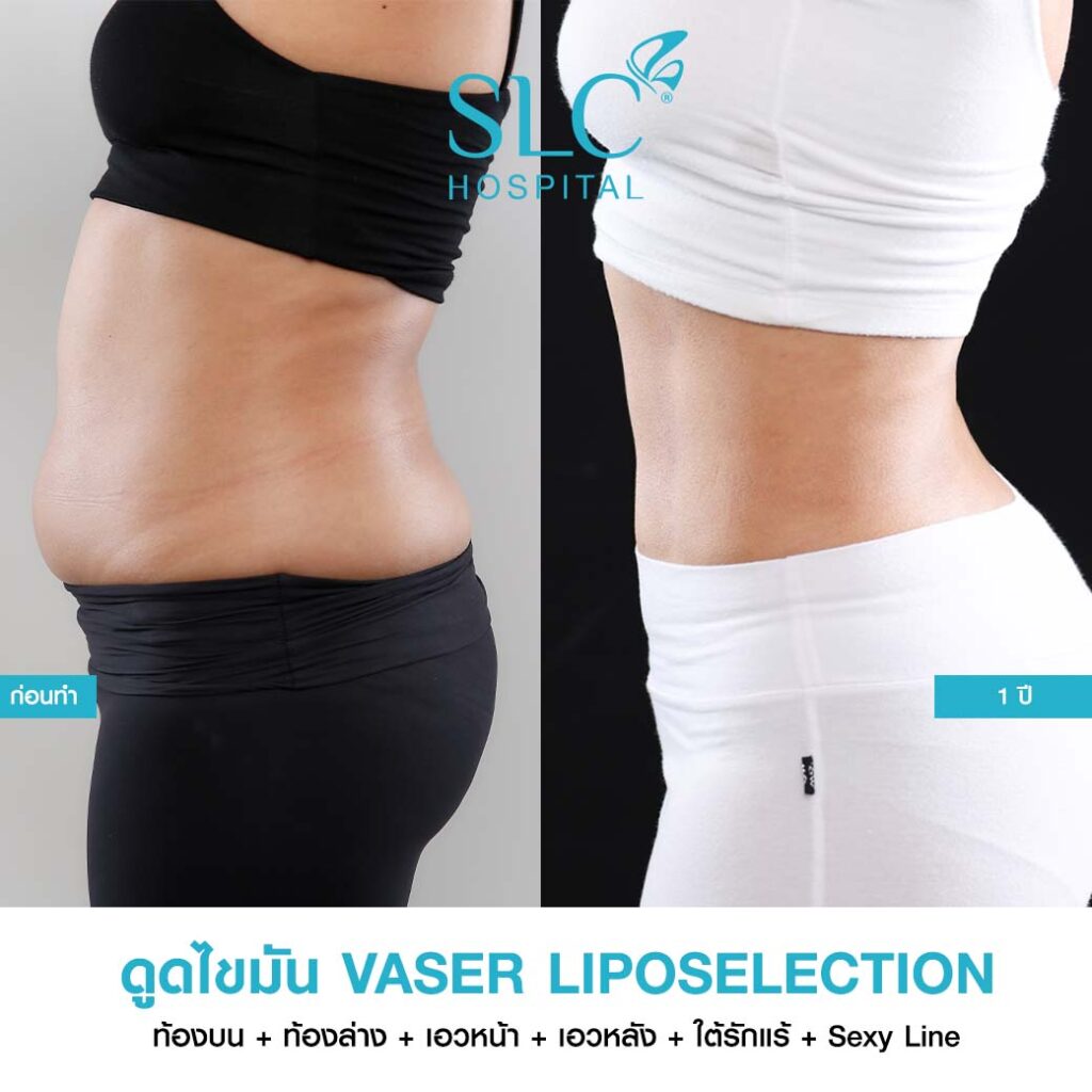 ดูดไขมัน Vaser LipoSelection