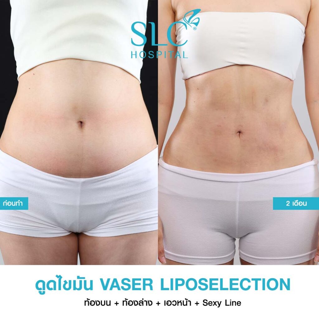 ดูดไขมัน Vaser LipoSelection