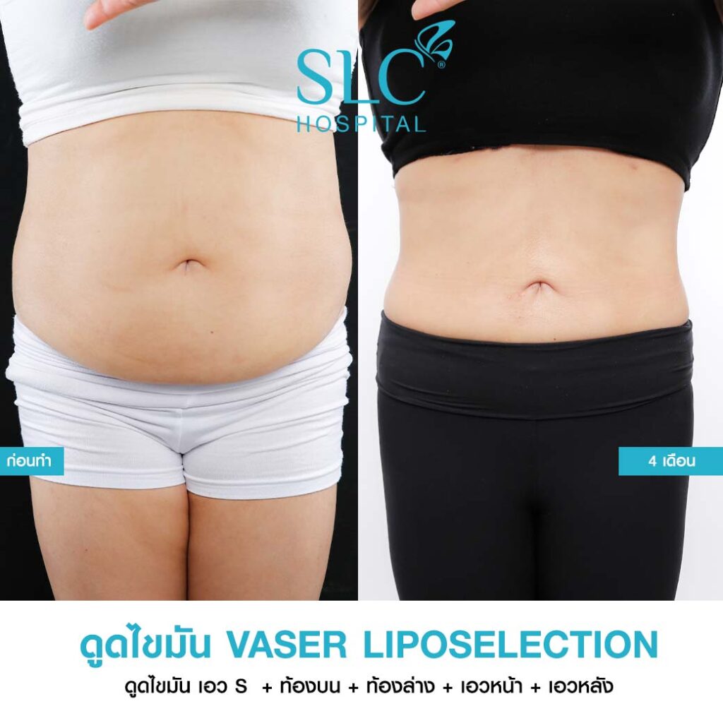 ดูดไขมัน Vaser LipoSelection