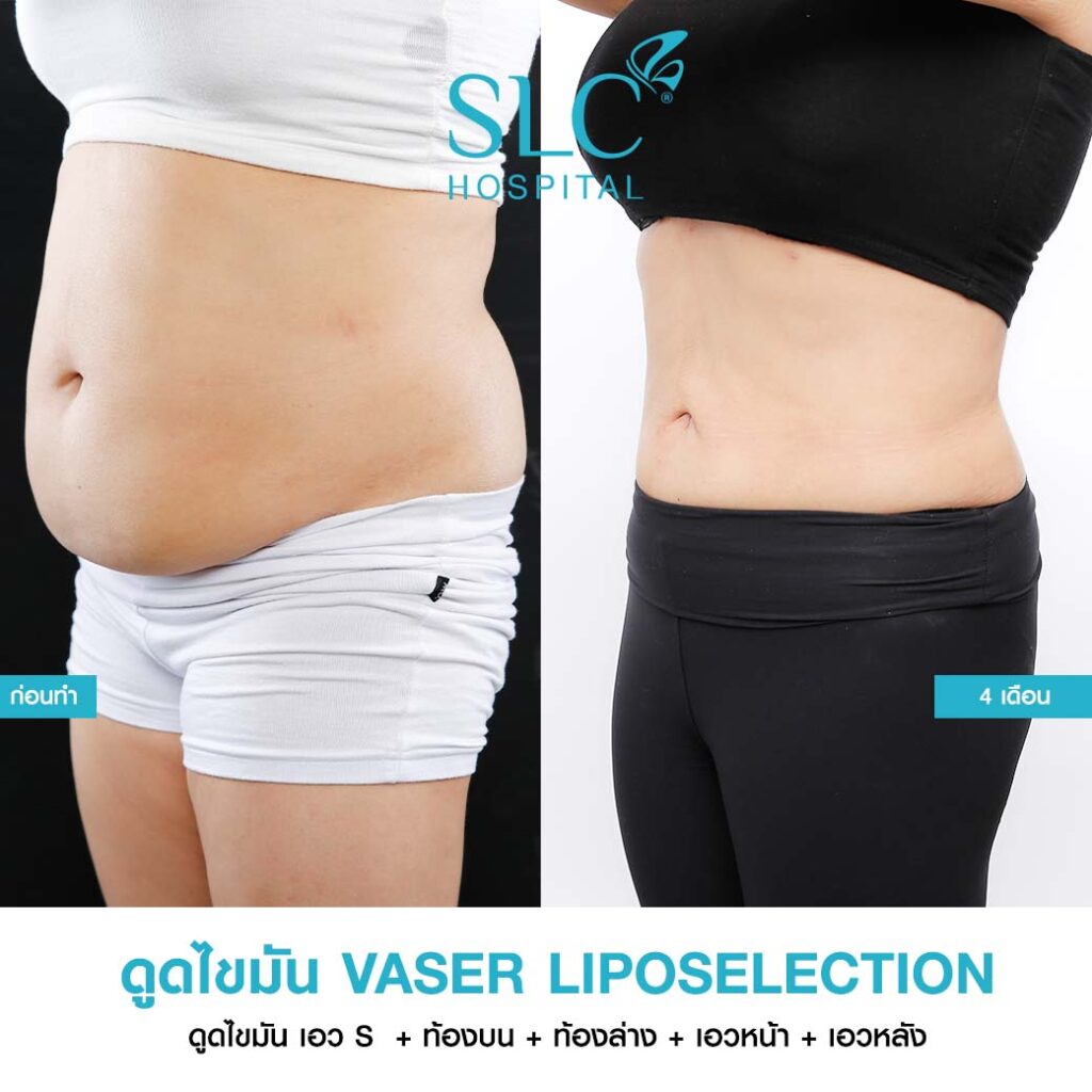 ดูดไขมัน Vaser LipoSelection