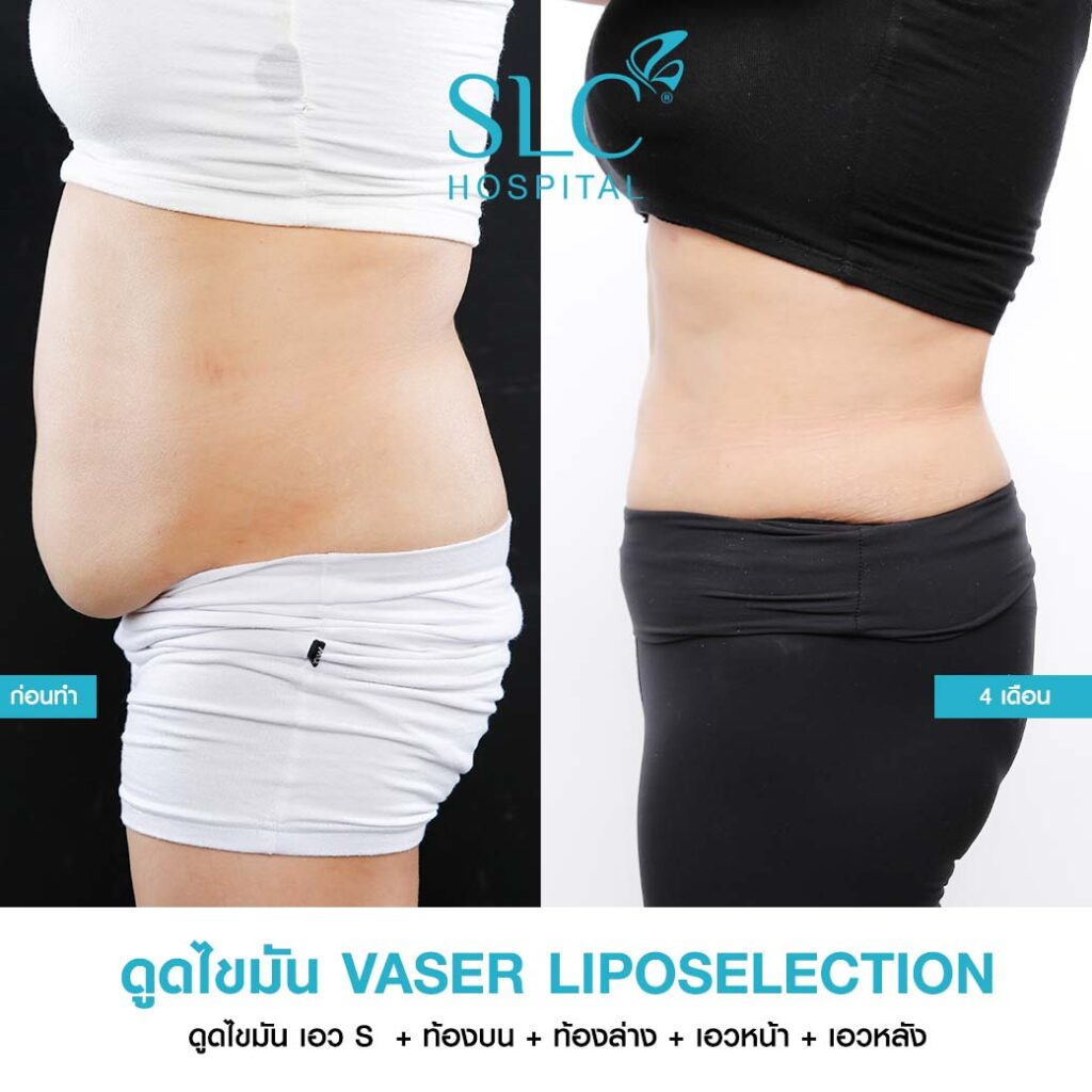 ดูดไขมัน Vaser LipoSelection