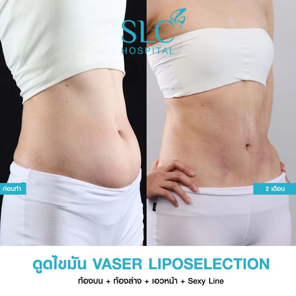 ดูดไขมัน Vaser LipoSelection