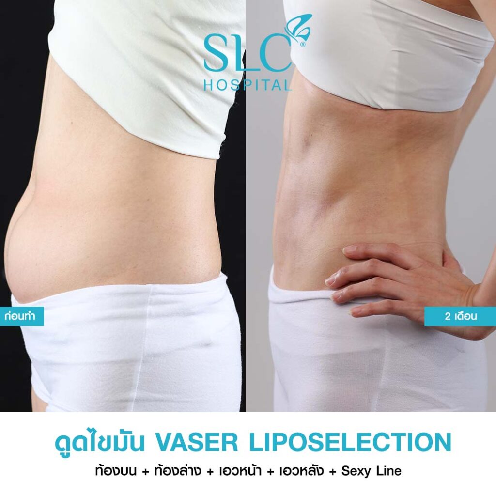 ดูดไขมัน Vaser LipoSelection