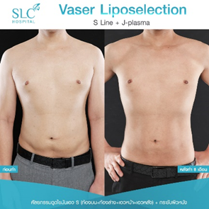 ดูดไขมัน Vaser LipoSelection