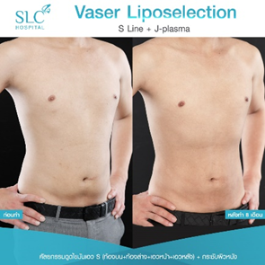 ดูดไขมัน Vaser LipoSelection