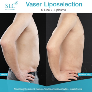 ดูดไขมัน Vaser LipoSelection