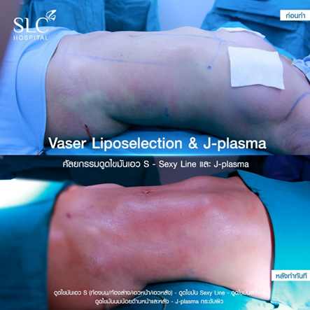 ดูดไขมัน Vaser LipoSelection