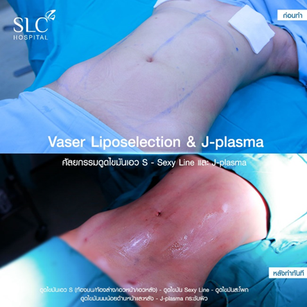 ดูดไขมัน Vaser LipoSelection