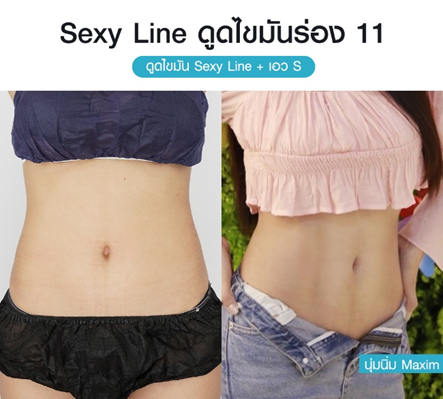 ดูดไขมัน Vaser LipoSelection