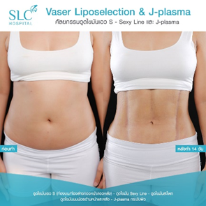 ดูดไขมัน Vaser LipoSelection