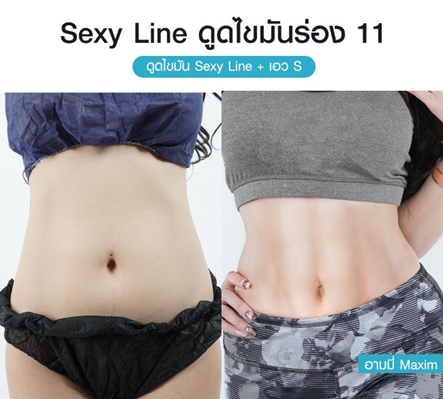 ดูดไขมัน Vaser LipoSelection