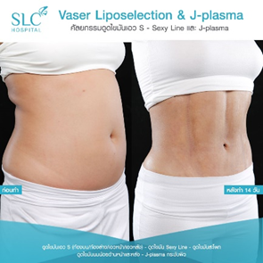 ดูดไขมัน Vaser LipoSelection