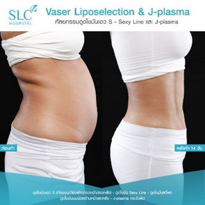 ดูดไขมัน Vaser LipoSelection