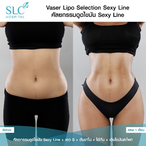 ดูดไขมัน Vaser LipoSelection