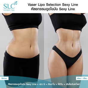 ดูดไขมัน Vaser LipoSelection