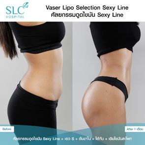 ดูดไขมัน Vaser LipoSelection