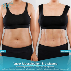 ดูดไขมัน Vaser LipoSelection