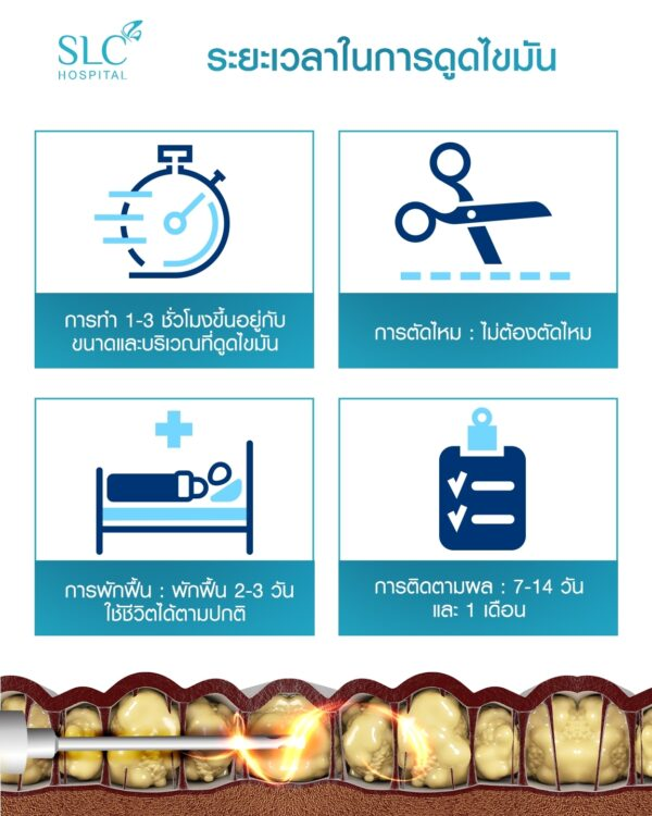 ระยะเวลาในการดูดไขมัน