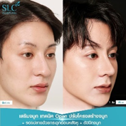 รีวิวทรงจมูกผู้ชาย