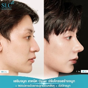 รีวิวทรงจมูกผู้ชาย