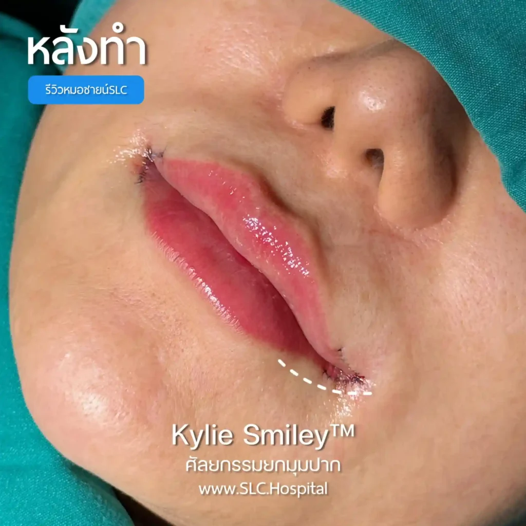 ศัลยกรรมยกมุมปาก ราคา